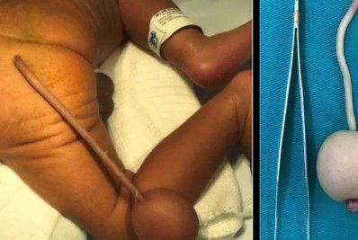 Caso raro! Bebê nasce com cauda de 12 cm