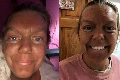 Mulher exagera no bronzeamento artificial três dias antes de ir a um casamento