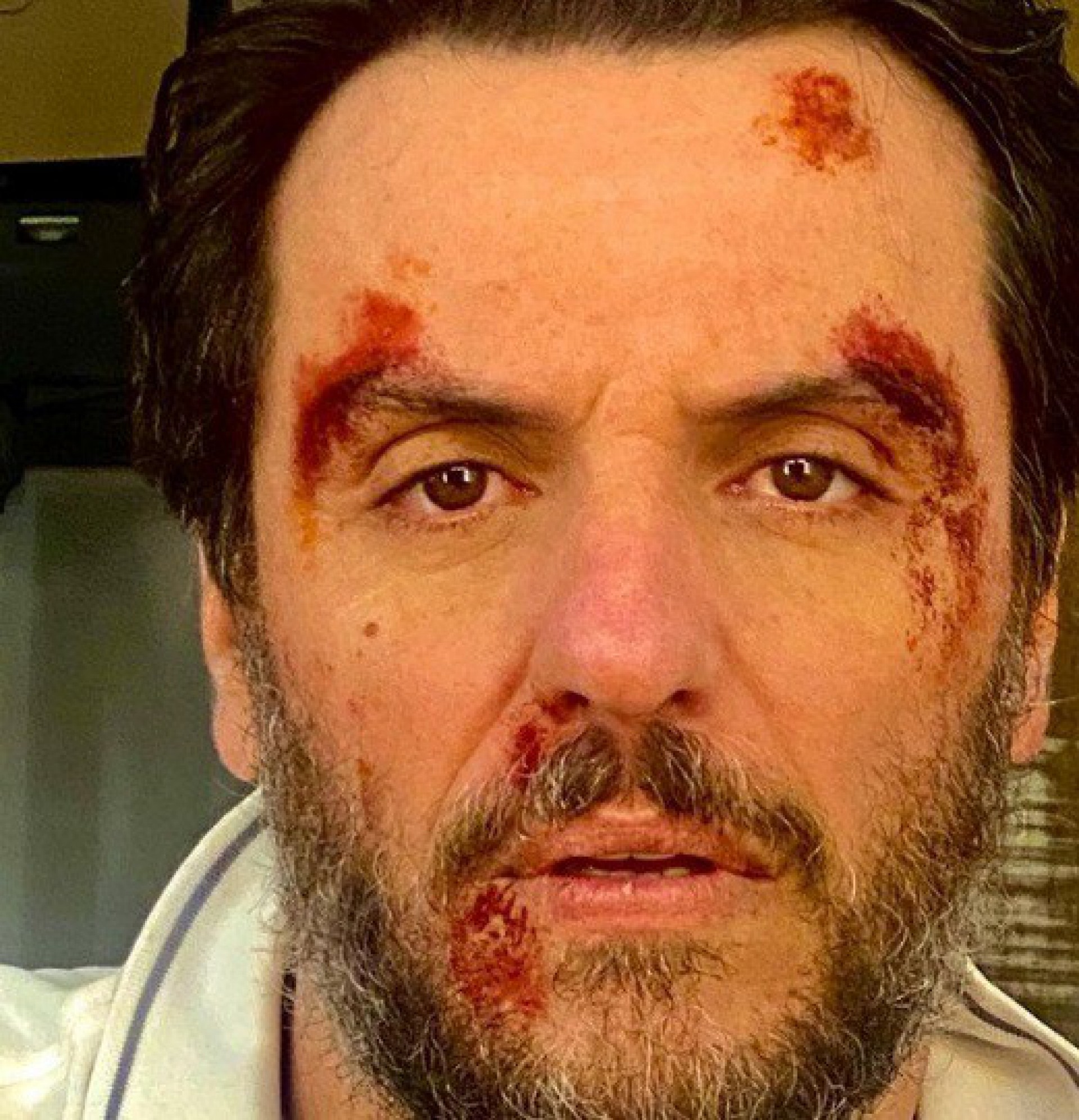 Rodrigo Lombardi surge com rosto machucado - Reprodu&ccedil;&atilde;o Internet