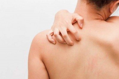 Paraíba registra primeiros casos de 'surto' de coceira