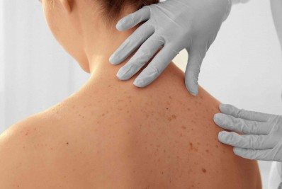 Dezembro Laranja: Especialista faz alerta para os riscos do câncer de pele