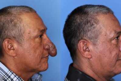 Homem relata felicidade ao operar 'pênis no nariz': 'Presente de Natal'