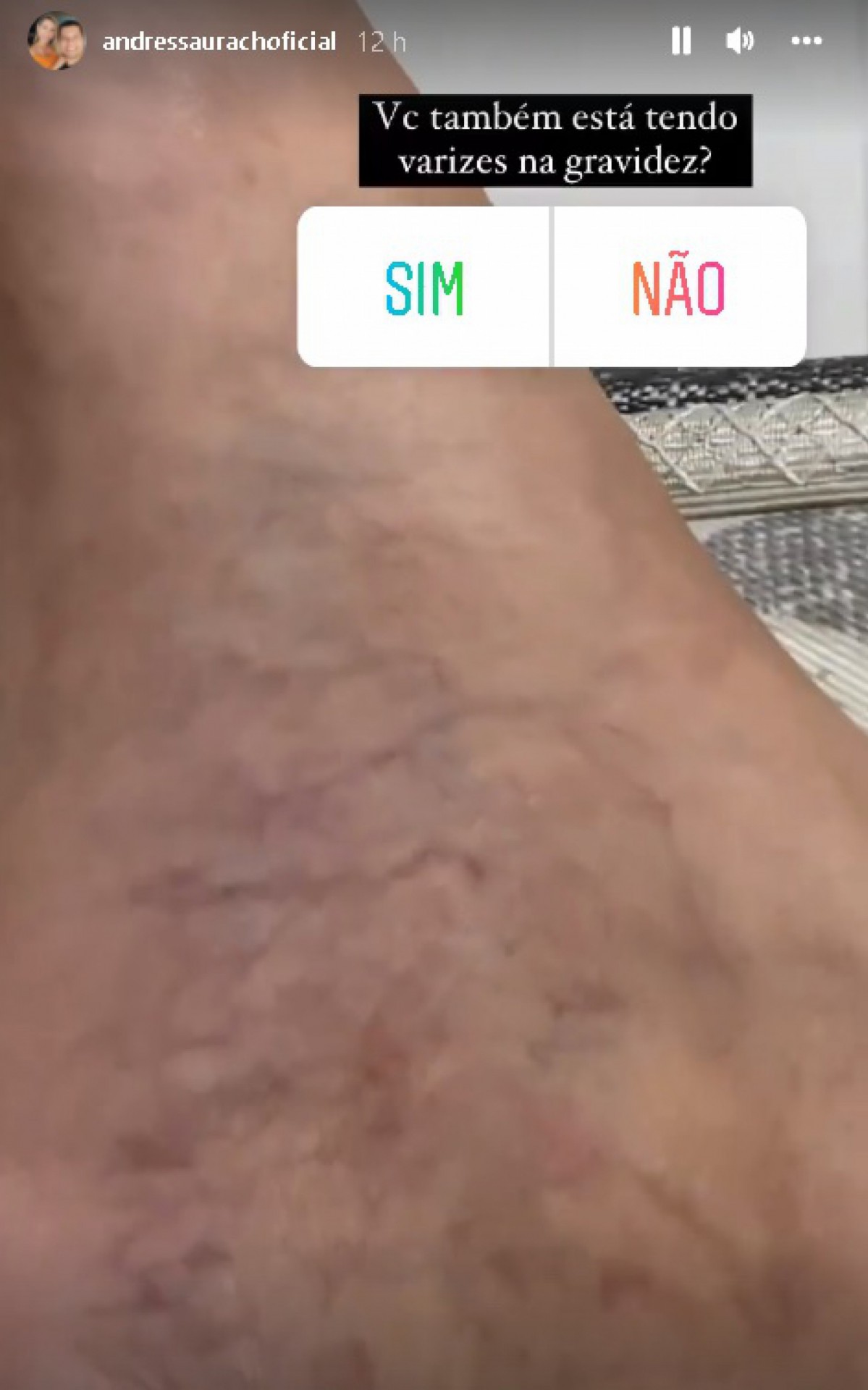 Andressa Urach relata aparecimento de varizes durante gravidez - Reprodução/Instagram