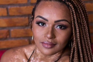 Entenda o que é o vitiligo: condição que ‘rouba’ a melanina da pele