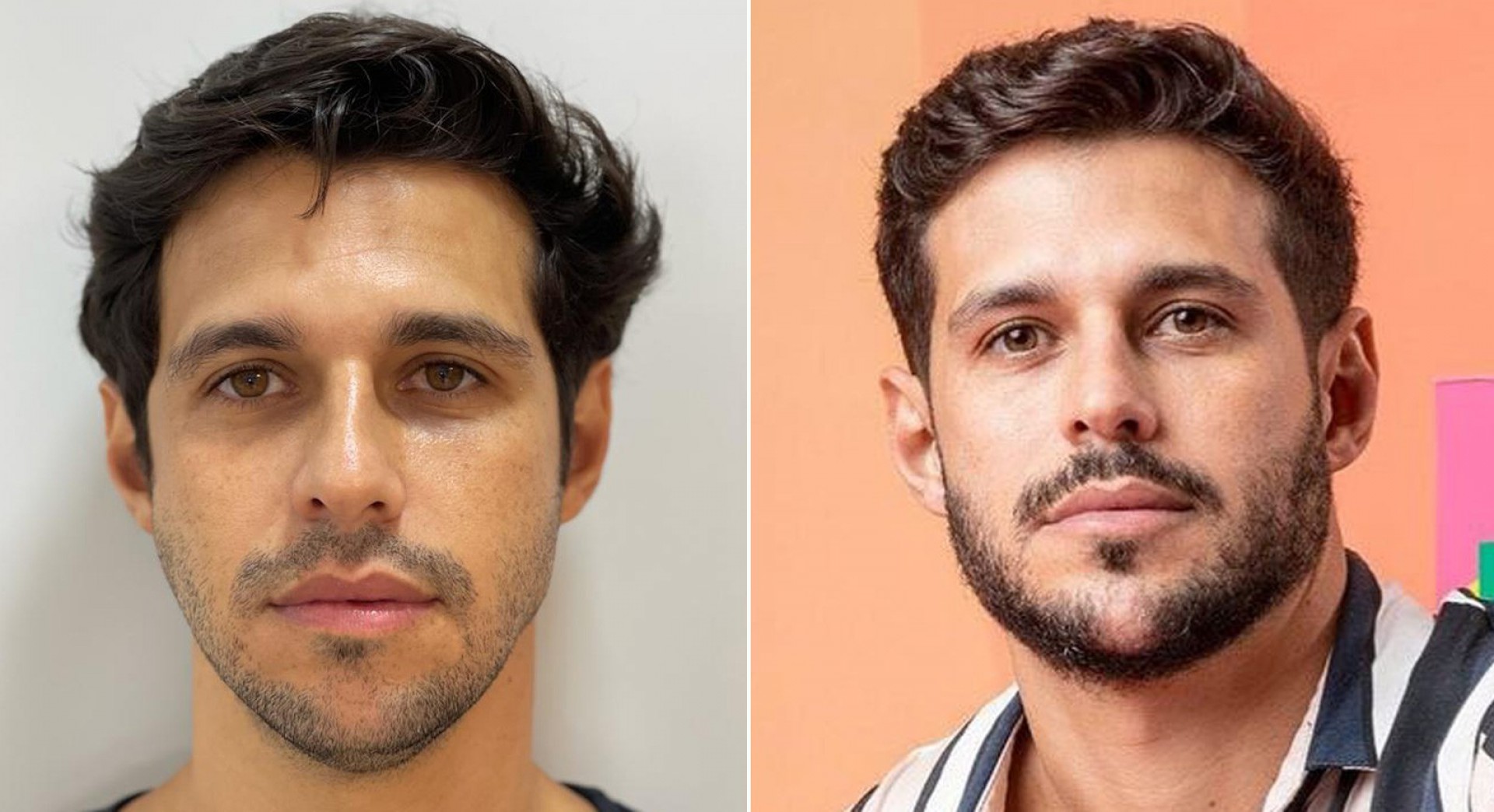 Antes e depois: Rodrigo passou por harmonização facial antes de entrar no 'BBB 22' - Reprodução