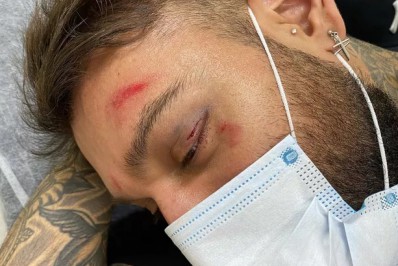 Lucas Lucco mostra hematomas após tombo: 'Rolê diferenciado'