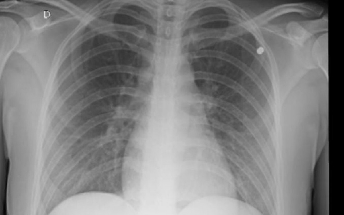Radiografia de Rafaela Ribeiro mostra projétil alojado no tórax - Foto: Arquivo pessoal