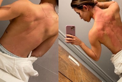 Ex-BBB Larissa Tomásia exibe manchas no corpo após crise alérgica