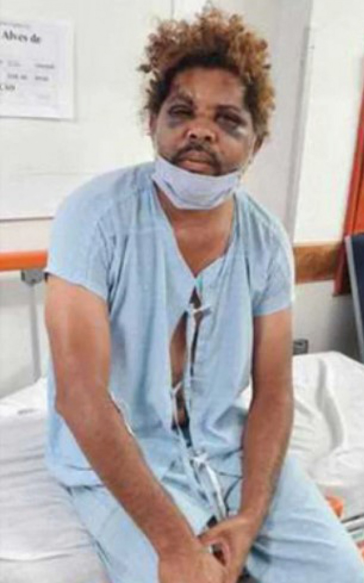 Gilvaldo teve uma costela quebrada e um edema no rosto - Reprodução