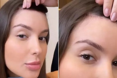 Thais Braz mostra a cicatriz de sua cirurgia na testa