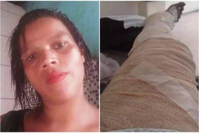 Mulher morre após ter 85% do corpo queimado enquanto cozinhava com álcool