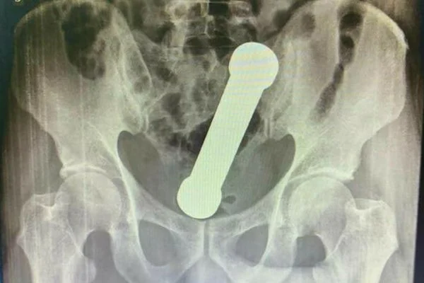 M&eacute;dicos encontram peso de academia de 2 quilos dentro de paciente
 - Reprodu&ccedil;&atilde;o 