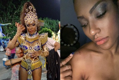 Rainha da Unidos da Ponte revela hematomas no corpo após desfilar na Sapucaí