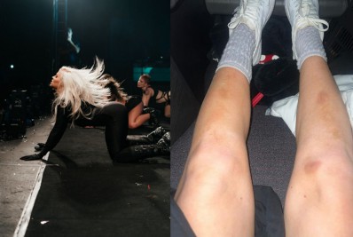 Luísa Sonza exibe hematomas causados por coreografias