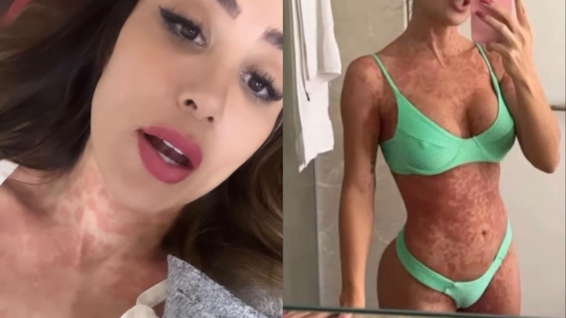 Com diversas manchas no corpo, Letícia Santiago revelou que ainda não sabe a causa da inflamação na pele - Reprodução