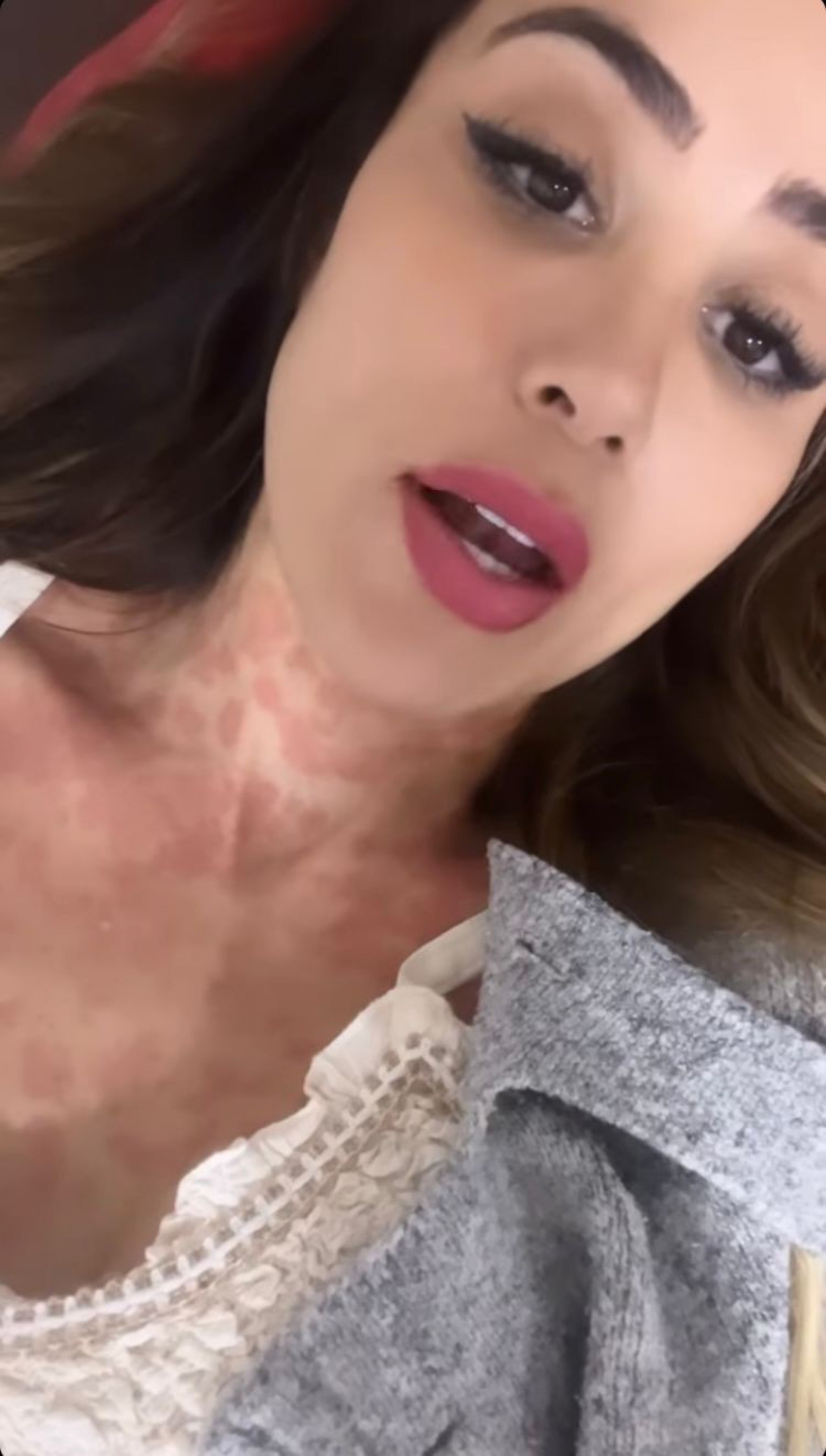 Com diversas manchas no corpo, Letícia Santiago revelou que ainda não sabe a causa da inflamação na pele - Reprodução