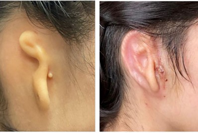 Médico americano realiza inédito implante de orelha impressa a partir de células humanas