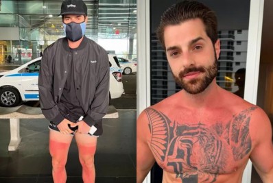 Alok choca seguidores ao mostrar queimaduras provocadas pelo sol: 'Não aprendo'