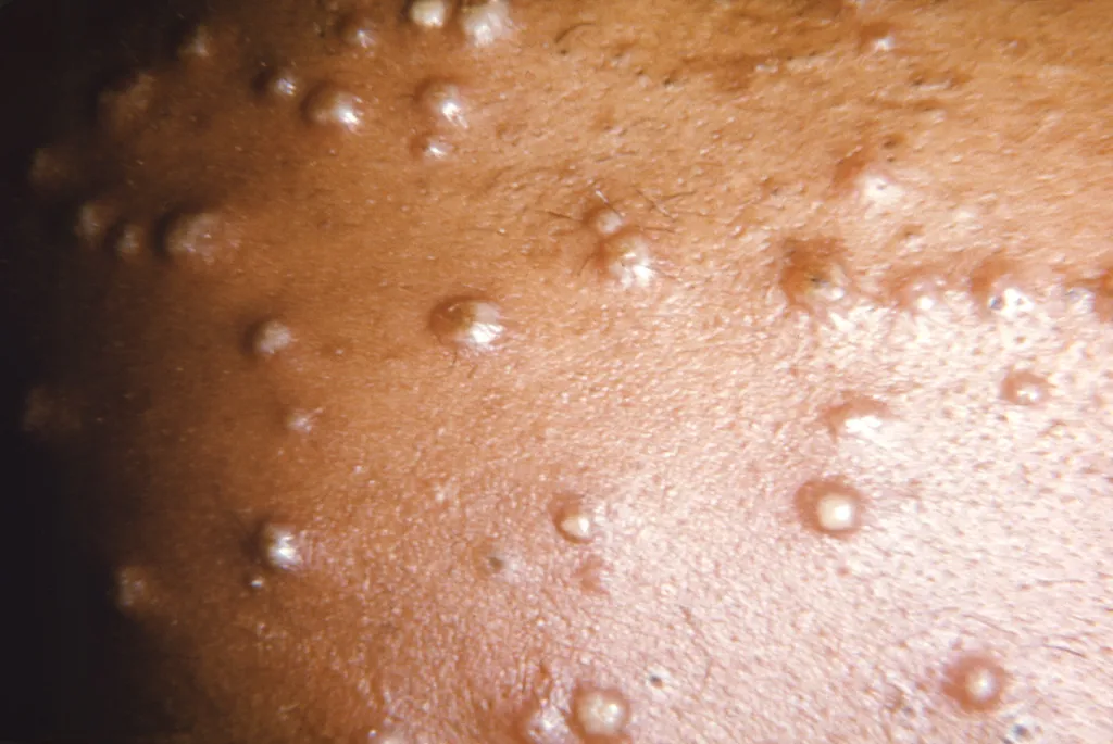 Varíola dos macacos: Rio tem 16 casos confirmados; Brasil já soma 76 infectados