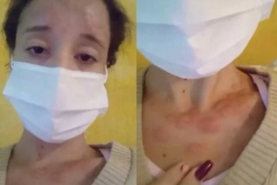 Secretaria Estadual de Saúde descarta caso de Varíola dos Macacos em Itaguaí