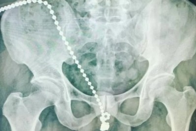Homem passa por cirurgia após inserir corrente com bolinhas de metal na uretra