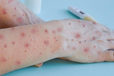 OMS cobra medidas urgentes da Europa para conter varíola do macaco