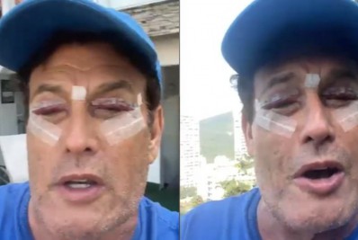 Sérgio Mallandro mostra recuperação após cirurgia nas pálpebras