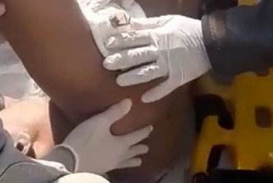 Base de guarda-sol perfura axila de turista em Cabo Frio