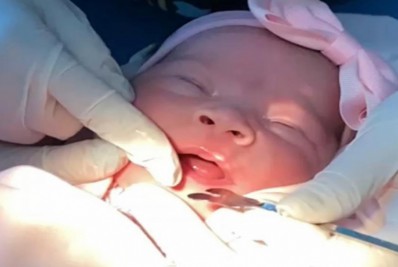 Intervenção cirúrgica para correção do freio da língua foi realizada pela primeira vez por equipe do Centro De Especialidades Odontológicas do município