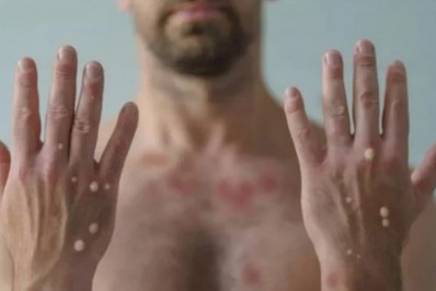 Casos de varíola dos macacos crescem 74% em duas semanas em todo o mundo