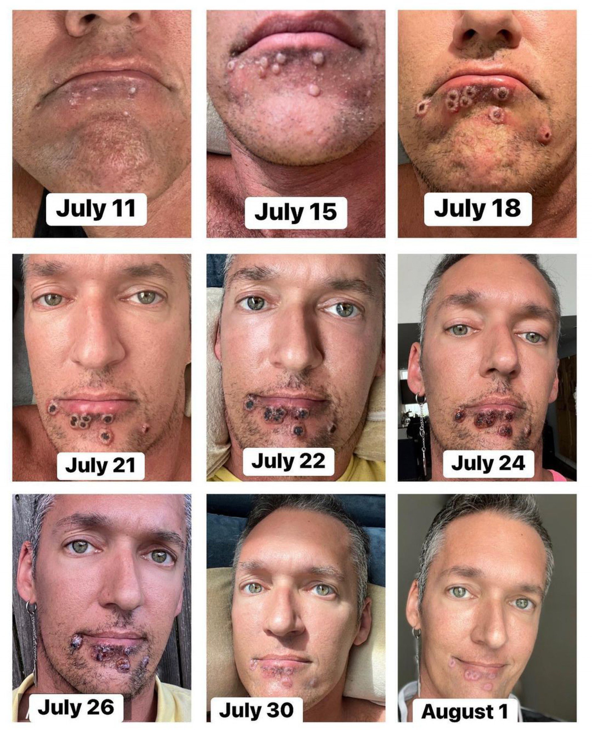 Porn Actor Silver Steele Shows The Evolution Of Monkey Smallpox In His Body