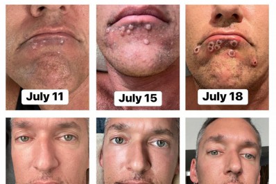 Ator pornô pega varíola dos macacos e mostra evolução da doença na web
