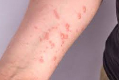 EUA registram primeira morte por varíola dos macacos