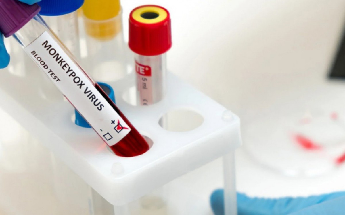 Quatro postos de coleta de material para testagem de Monkeypox serão abertos no estado a partir de sexta-feira - Divulgação/MS