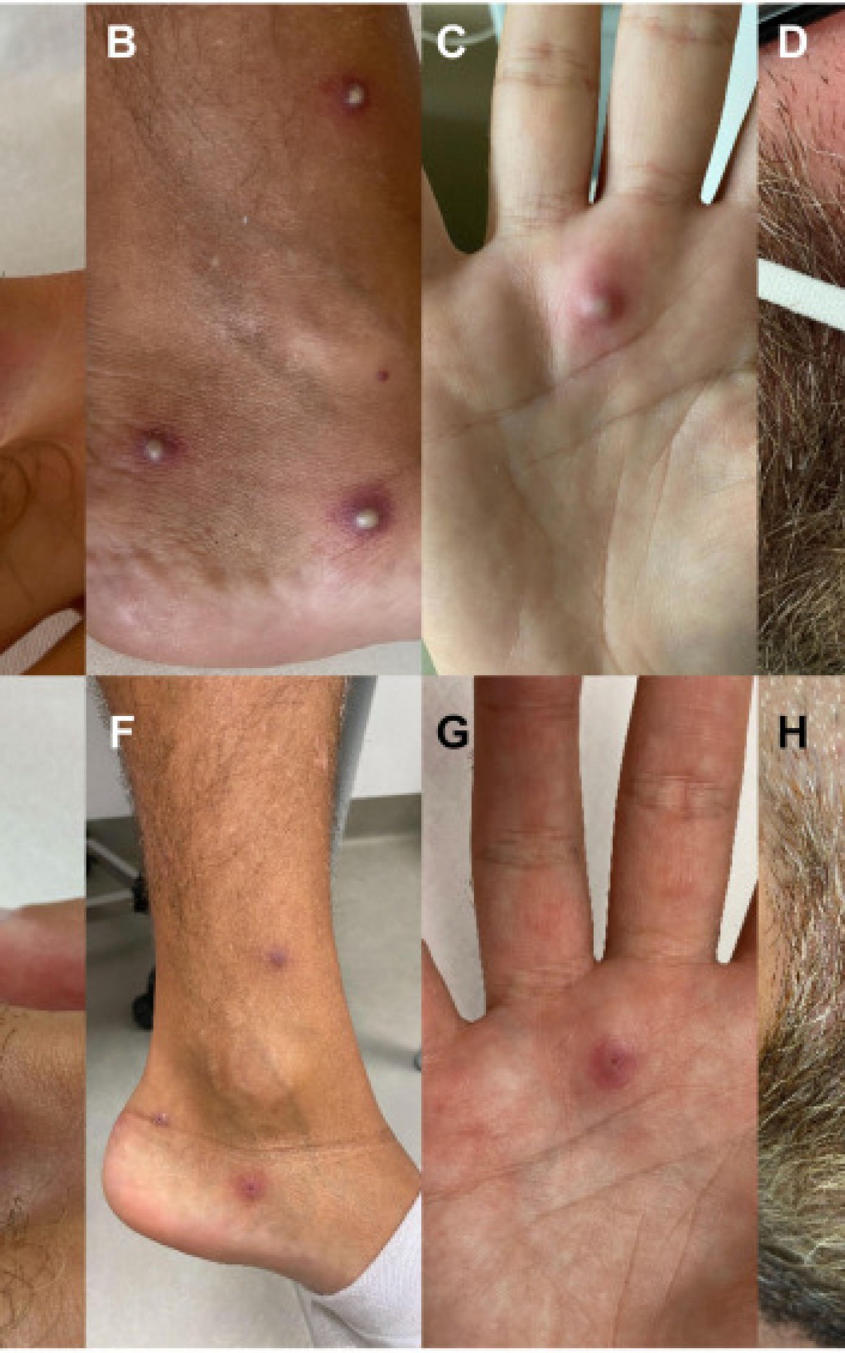 Paciente havia visitado a Espanha no m&ecirc;s de julho - Reprodu&ccedil;&atilde;o/Journal Of Infection