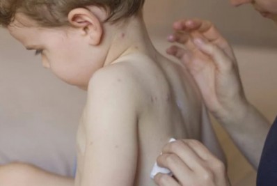 Criança de dois anos testa positivo para varíola dos macacos em Araruama