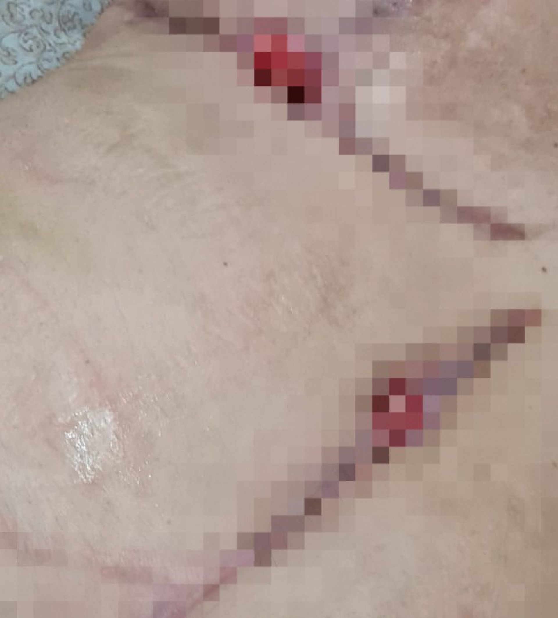 Ferimentos abertos no corpo de Daiana após erro na cirurgia plástica - Arquivo pessoal