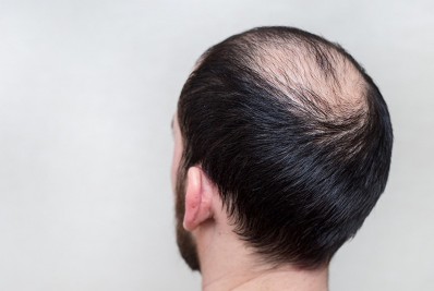 Minoxidil vira comprimido e ganha nova força em combate à calvície