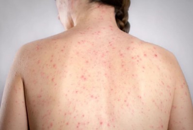 Sarampo: Ministério da Saúde faz busca ativa de casos da doença nesta terça-feira