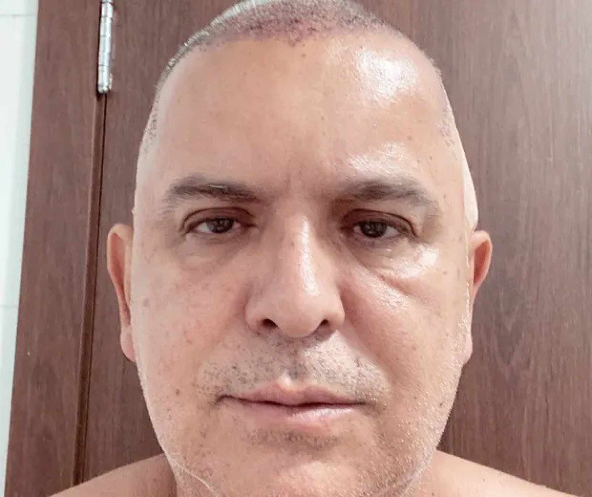 Orlando Morais passa por implante capilar - Reprodução / Instagram