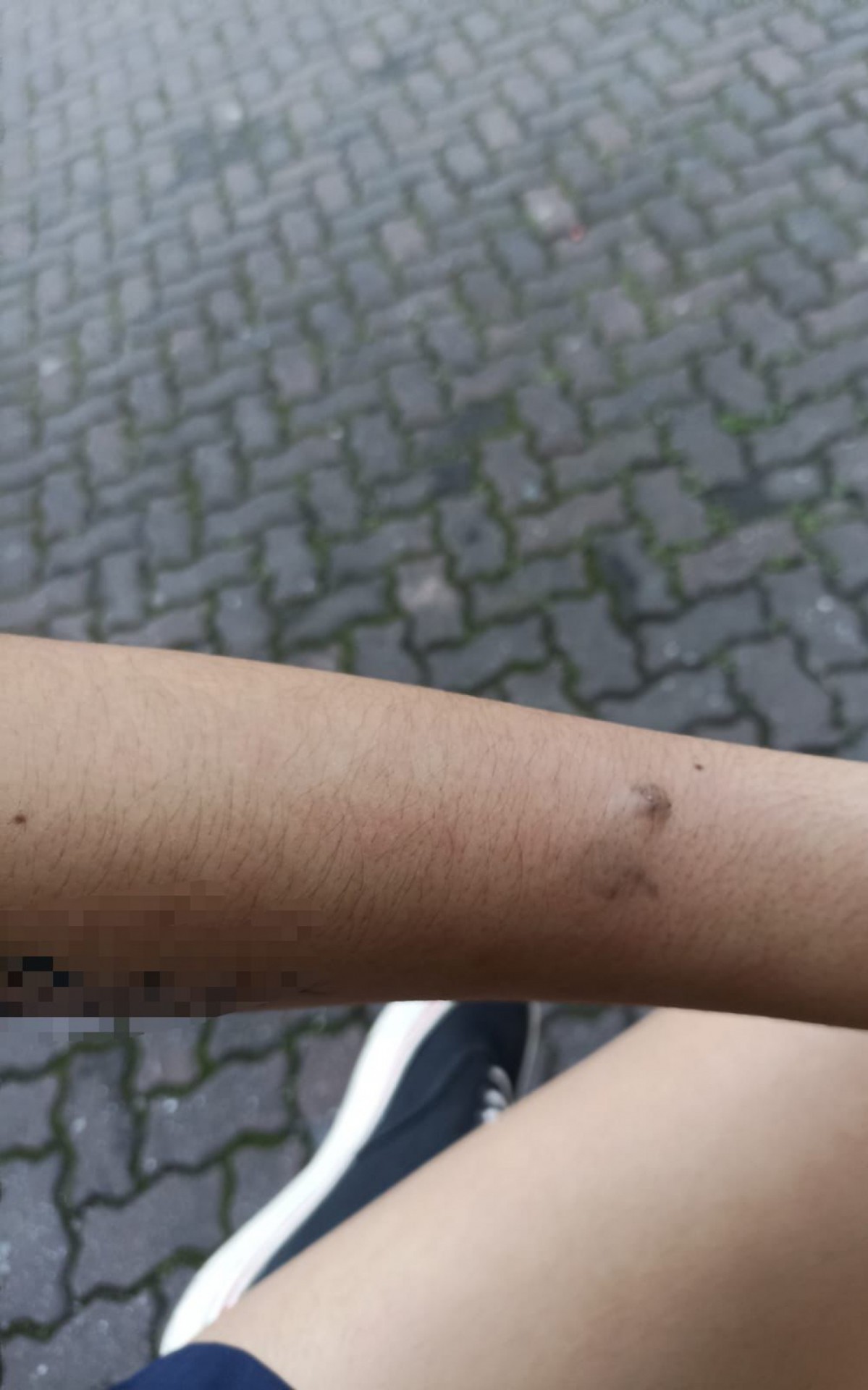 A jovem apresentou hematomas no braço - Foto: Arquivo Pessoal