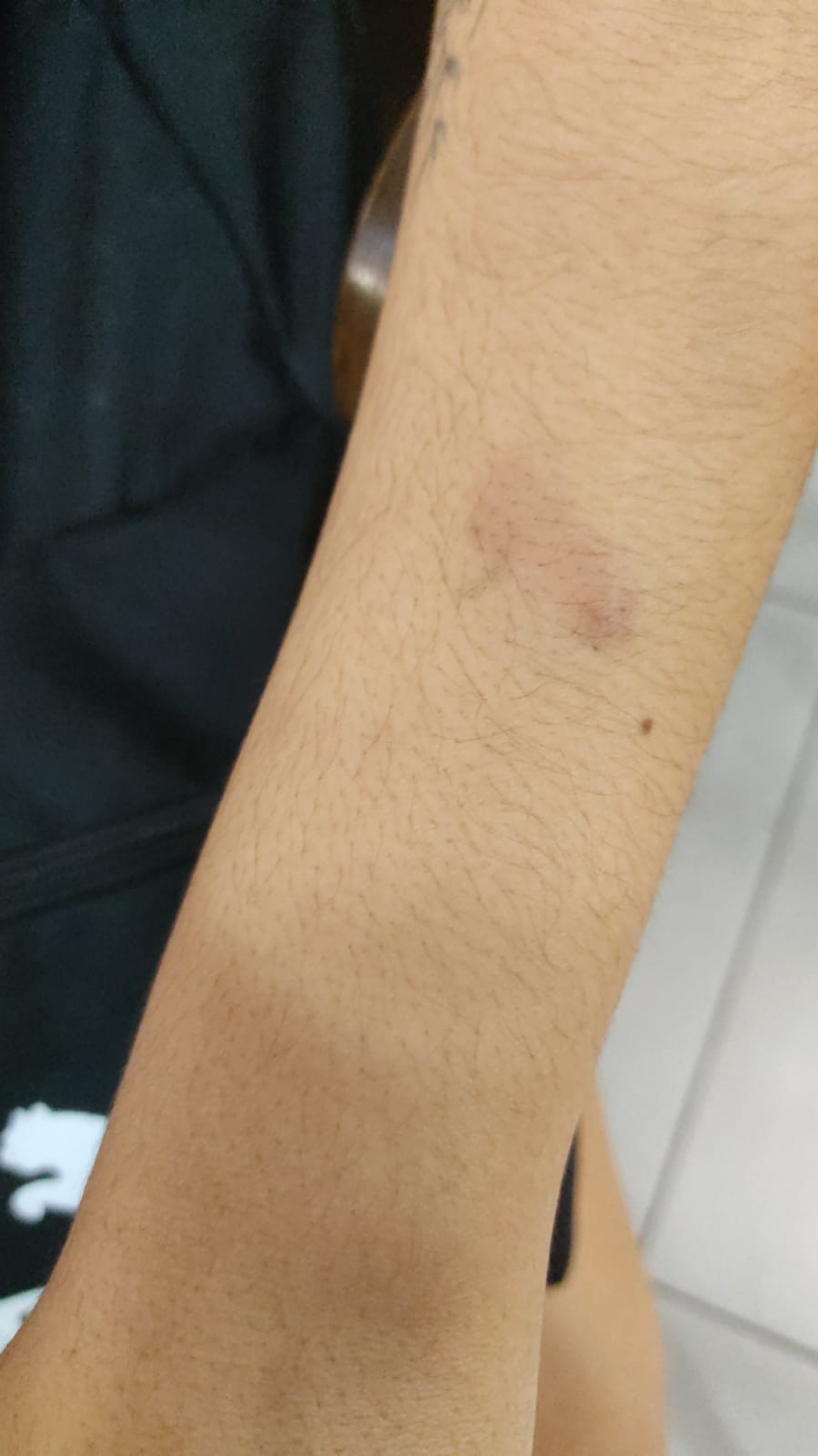 Laudo m&eacute;dico atestou presen&ccedil;a de hematomas no bra&ccedil;o da estudante