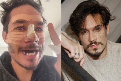 Após rinoplastia, Eliezer surge sem dente e com curativos no rosto: 'Estou lindo'