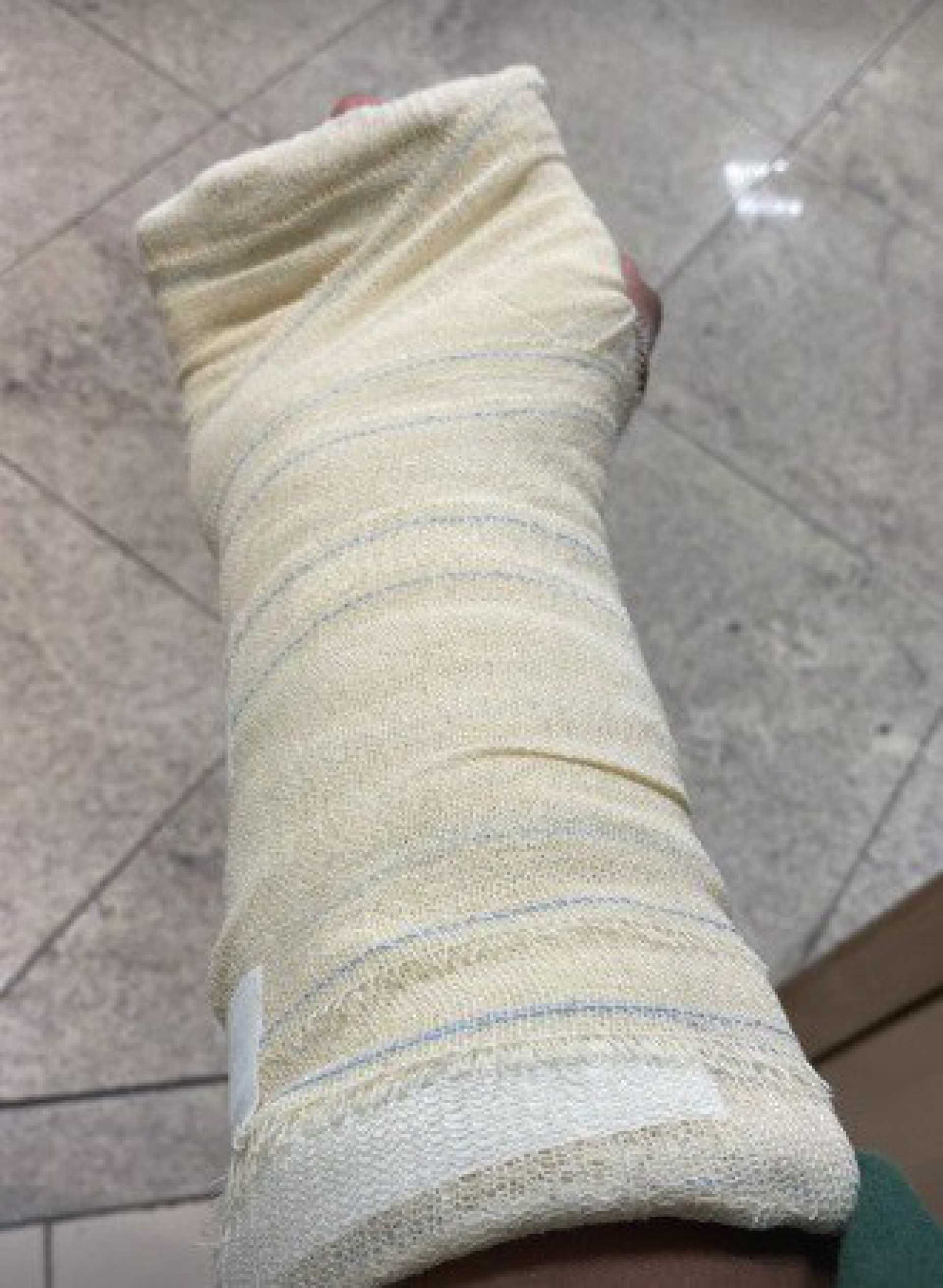 Mois&eacute;s Lopes acabou tendo o dedo quebrado durante o ataque e precisou enfaixar parte do antebra&ccedil;o