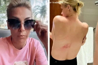 Ana Hickmann sofre acidente a cavalo e mostra hematomas: 'Fiquei sem ar'