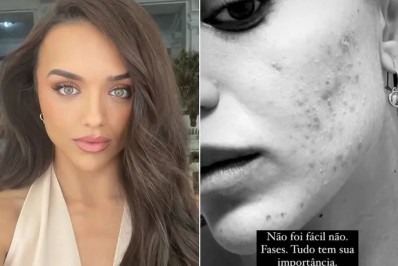 Rafa Kalimann mostra rosto com acne e desabafa sobre insegurança: 'Não foi fácil'