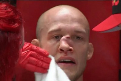 Médico mostra como traumas no nariz podem causar riscos para lutadores profissionais