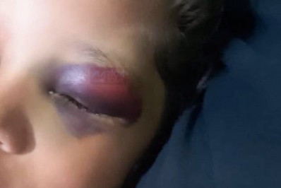 Criança chega em casa de escola municipal de Maricá com lesão grave no olho