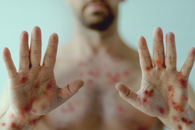 Macaé registra primeiro caso de varíola dos macacos