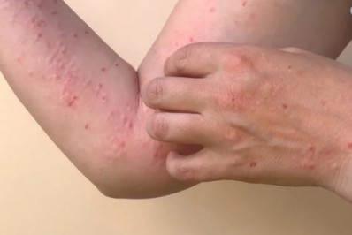 OMS muda o nome da varíola dos macacos para 'mpox'